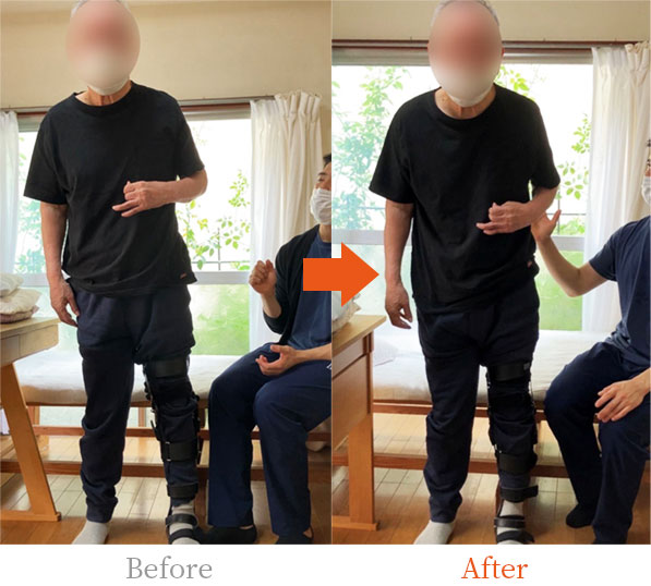 装具を外した訓練で改善した姿勢のビフォーアフター。